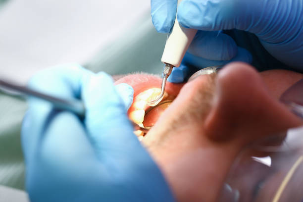 Best Emergency Tooth Extraction in Worthington, KY